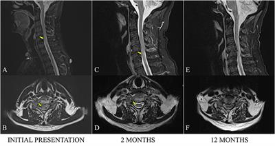 Double seropositive neuromyelitis optica associated with COVID-19: A case report